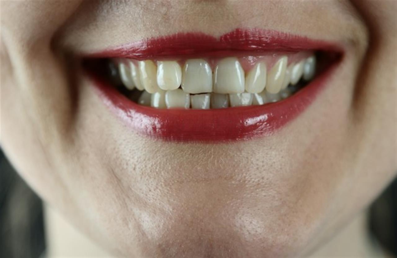 Tandpleje for voksne: Forebyggelse og behandling af huller i tænder